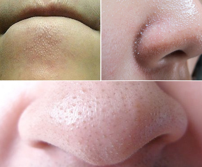 Tuyệt chiêu đối phó sợi bã nhờn hiệu quả