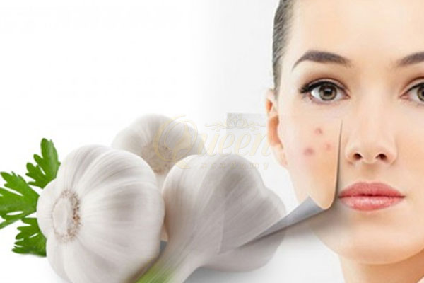 trị mụn tấy đỏ với tỏi 