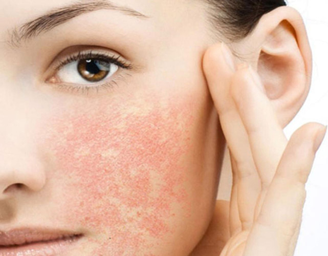 Cách điều trị và phục hồi da bị dị ứng mỹ phẩm an toàn tại nhà