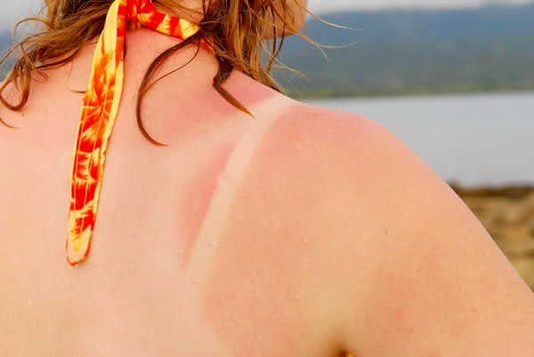 Hình ảnh hay gặp khi cháy nắng - Mẹo chữa da bị cháy nắng nhanh hiệu quả