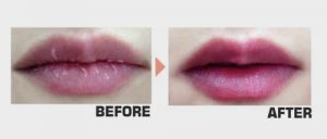 i môi trước và sau dưỡng 300x128 - Những sản phẩm dưỡng môi cho bạn có đôi môi mềm mại, căng mọng