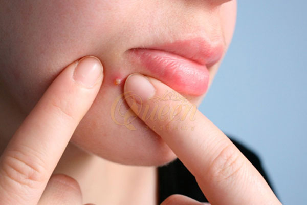 Cách nặn mụn tại nhà chuẩn spa