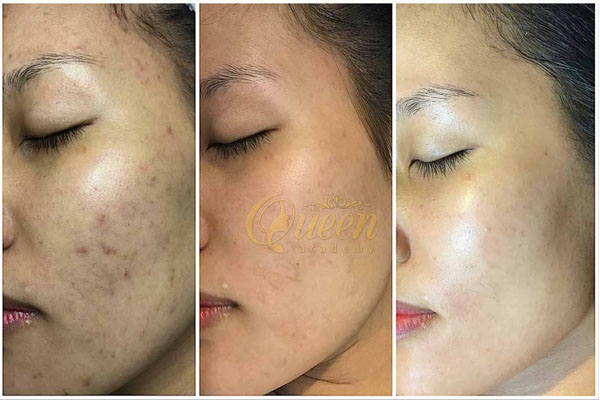 quy trình trẻ hóa làn da