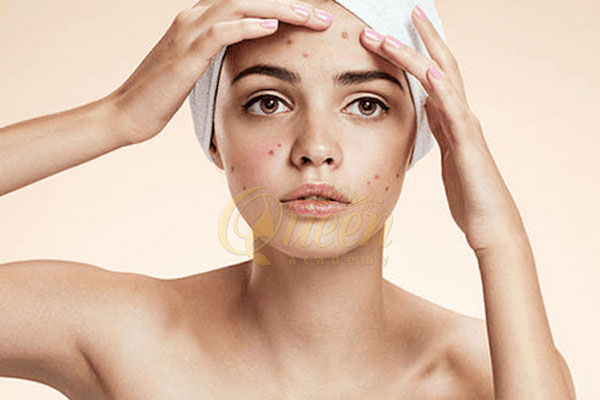 Nguyên nhân gây nổi mụn là gì? Chăm sóc da kỹ nhưng da vẫn bị nổi mụn