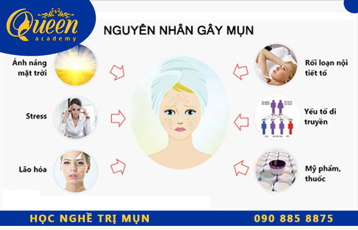 nguyên nhân gây ra mụn 