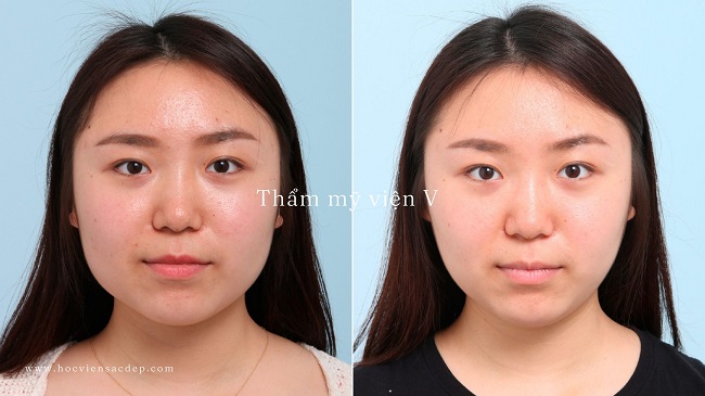 Xóa nếp nhăn bằng botox