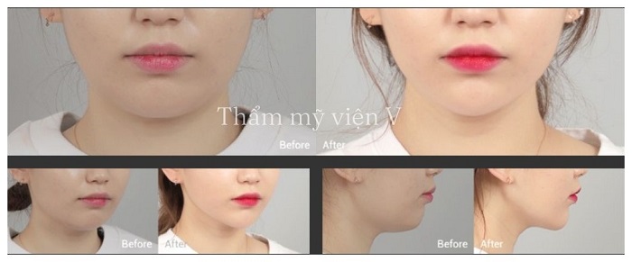 Tiêm tan mỡ nọng cằm tại Thẩm mỹ viện V