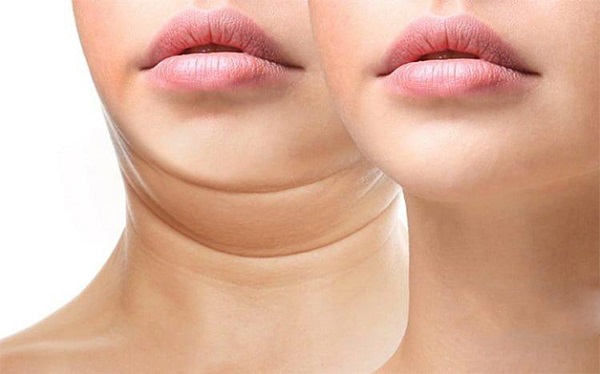 Phương pháp tiêm giảm mỡ là gì?