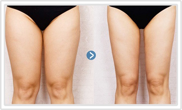 Những phương pháp tiêm giảm mỡ an toàn tại TpHCM