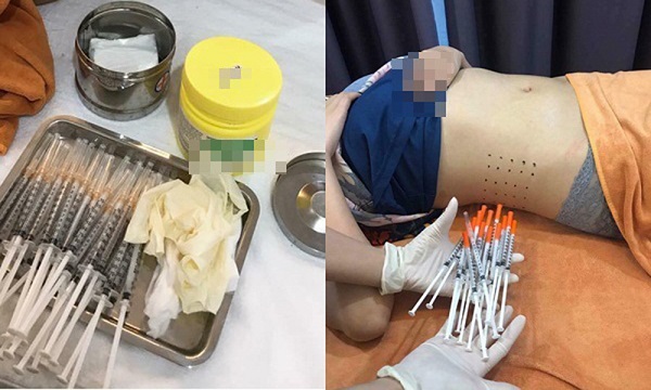 Phương pháp tiêm giảm mỡ có nguy hiểm không?