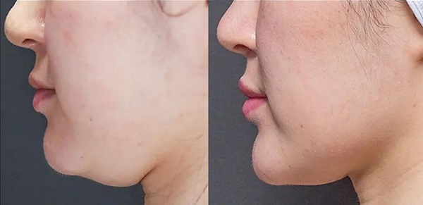 Tiêm tan mỡ nọng cằm