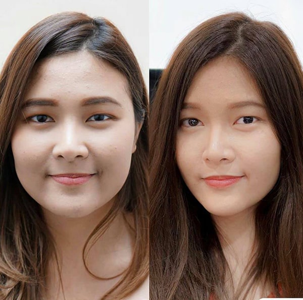 tiêm botox không sưng đau