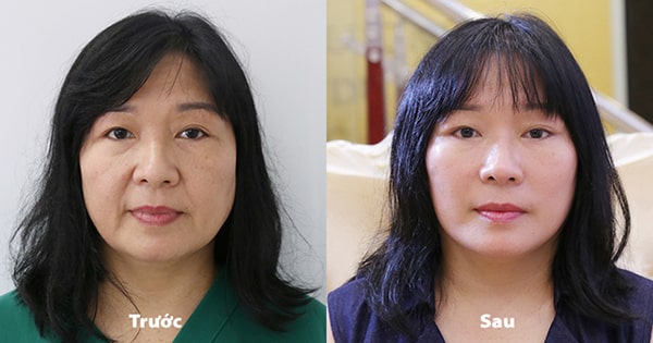 căng da mặt bằng chỉ tại Học viện sắc đẹp Fusion