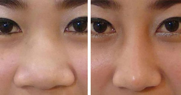 đối tượng thu gọn cánh mũi