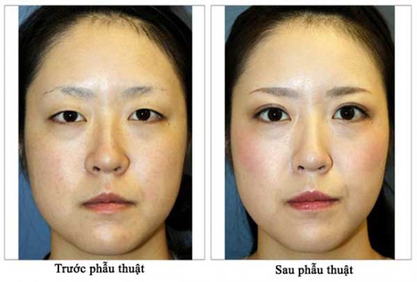 phương pháp thu nhỏ cánh mũi