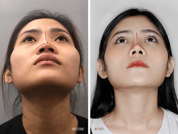 thu gọn cánh mũi thay đổi tài vận