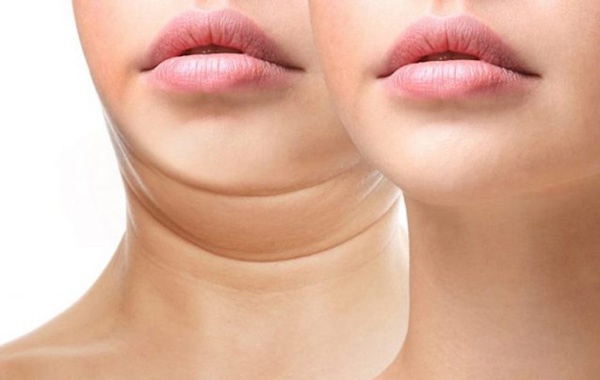 tiêm botox tan mỡ nọng cằm