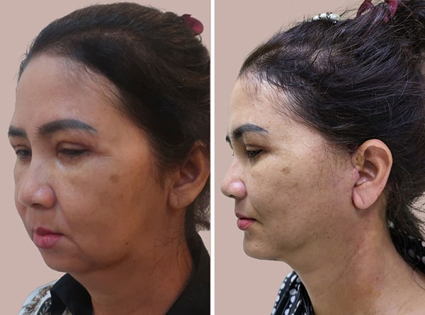 căng da mặt bằng chỉ nâng cơ mặt