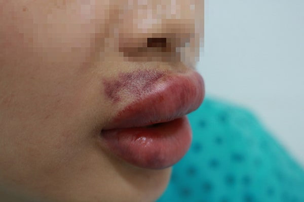 bầm tím môi khi tiêm filler
