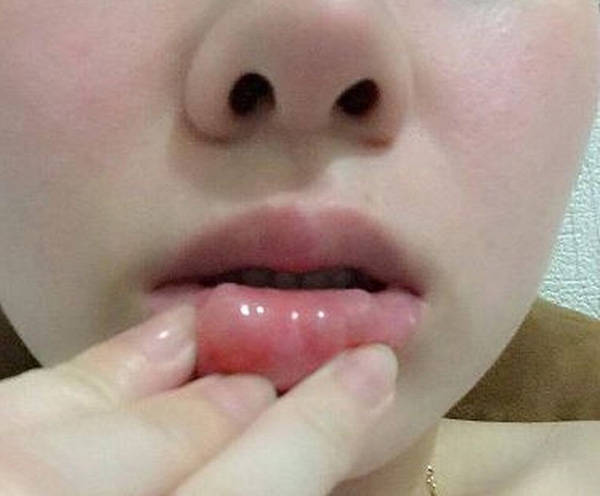 tiêm filler môi bị vón cục