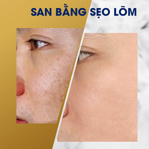 Khóa học cắt đáy sẹo