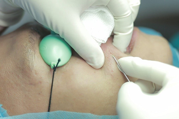 quy trình cắt đáy sẹo