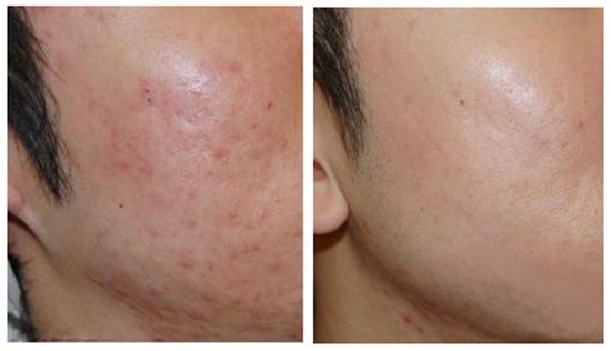 thơi gian học cắt đáy sẹo