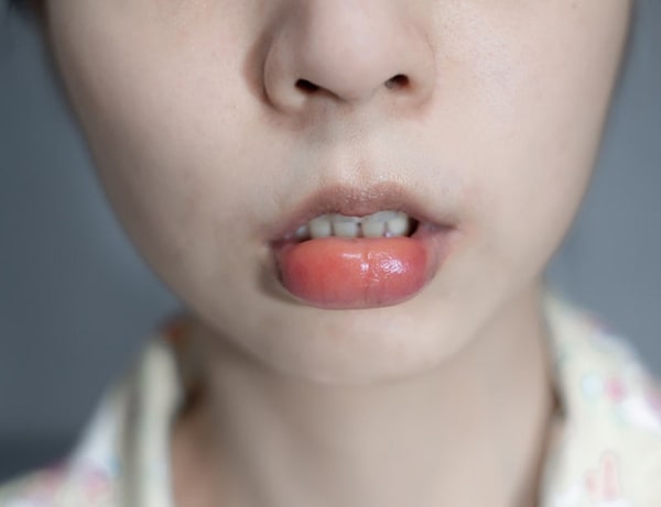 tiêm filler môi bị sưng