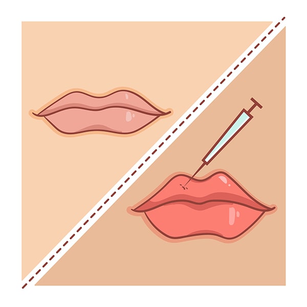 Tiêm filler môi có bị sưng không? Bao lâu hết sưng?