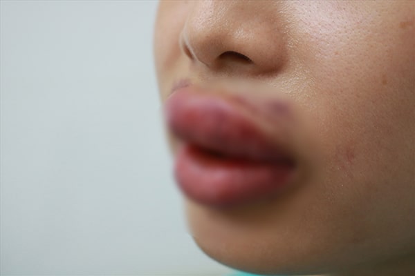 biến chứng tiêm filler môi bị sưng tím