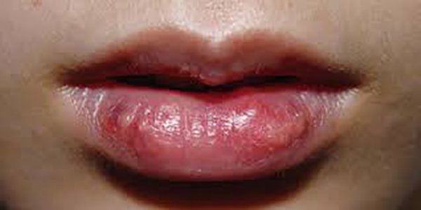 môi dị ứng sau tiêm filler