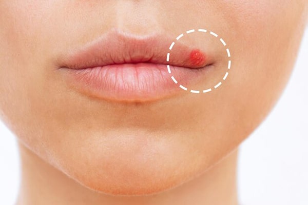 Lý do xảy ra các tác hại của phun xăm môi