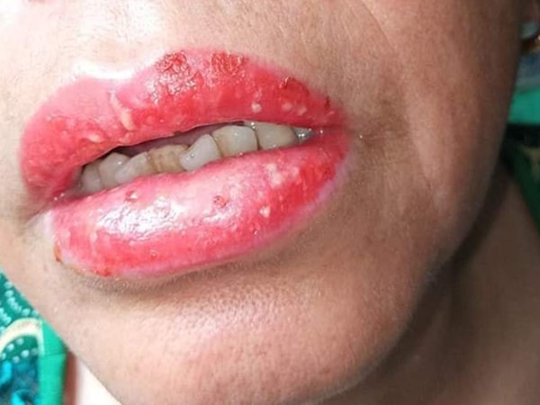 Phun môi bị phồng rộp, đau rát có ảnh hưởng gì không?