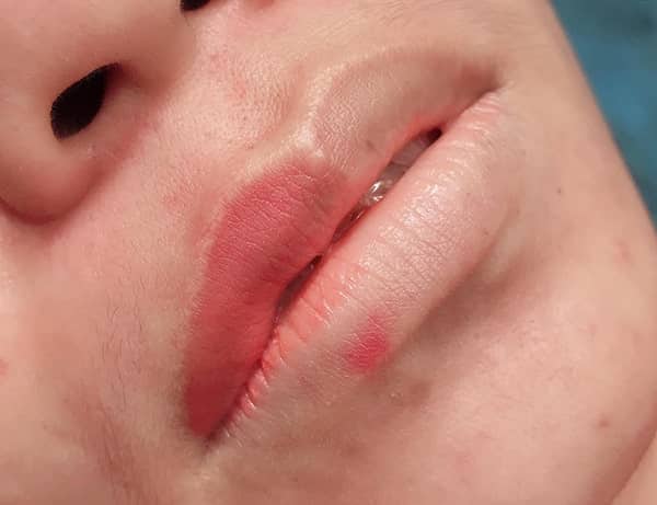 Dấu hiệu xăm môi mãi không lành
