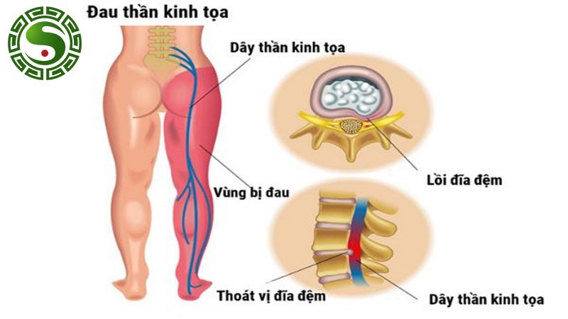 Đông Y Trị Thần Kinh Tọa: Phương Pháp Chữa Đau Thần Kinh Tọa Bằng Đông Y 