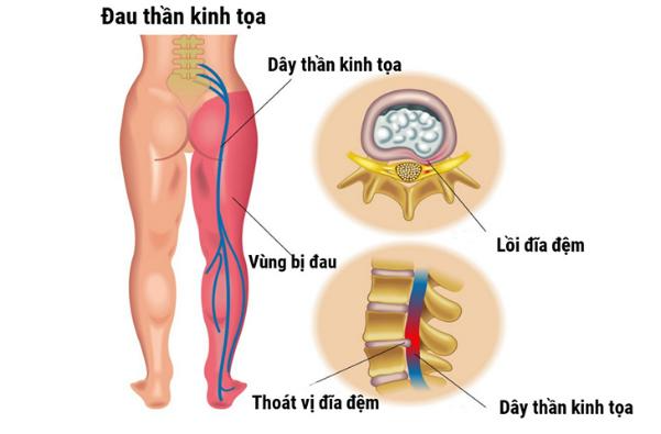 Tổng quan về thần kinh tọa