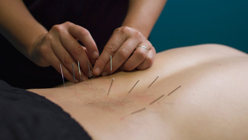 Châm cứu trị đau lưng