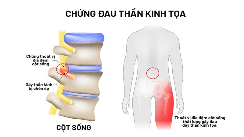 Triệu chứng thường gặp của đau thần kinh tọa