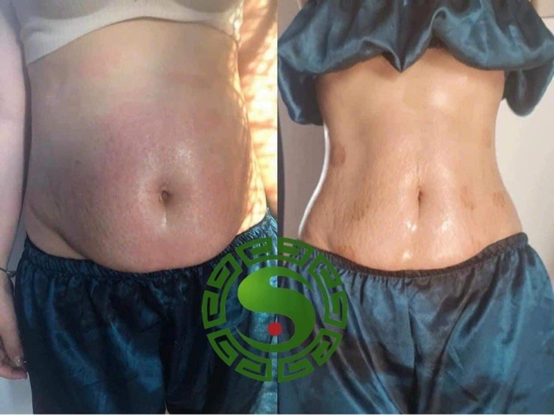 Hiệu quả sau liệu trình bấm nguyệt giảm cân