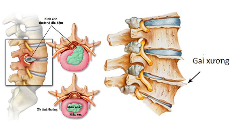Chữa Gai Cột Sống Bằng Đông Y: Phương Pháp Hiệu Quả Và An Toàn