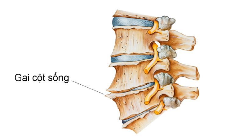 Gai cột sống là gì?