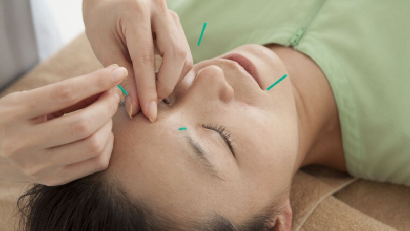 Châm cứu - phương pháp đông y chữa lo âu