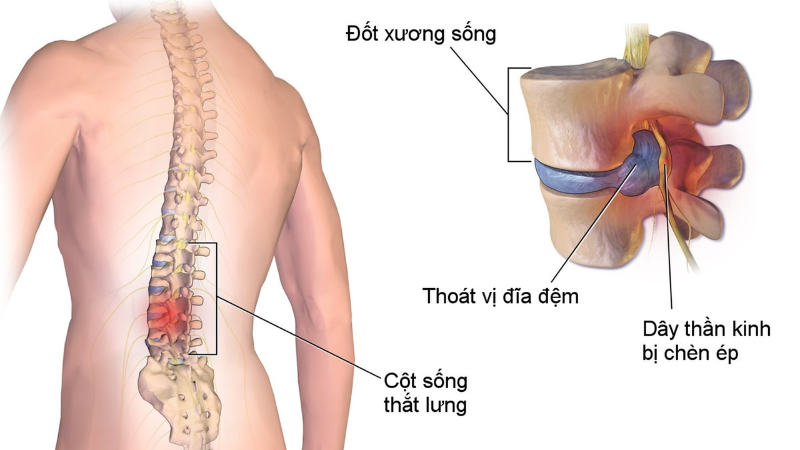 Đông Y Trị Thoát Vị Đĩa Đệm - Những Phương Pháp An Toàn Và Hiệu Quả