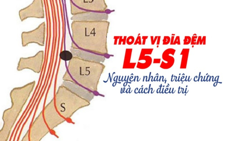 Mức Độ Nguy Hiểm Của Thoát Vị Đĩa Đệm L5 S1 Và Cách Điều Trị Hiệu Quả